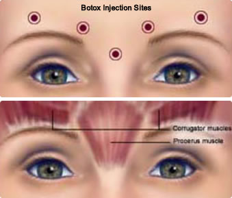 Botox injection sites